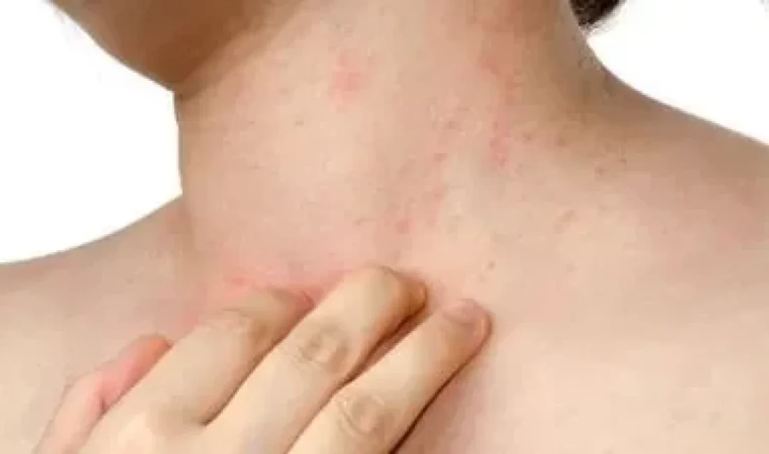 Memorial Kayseri Hastanesi Dermatoloji Uzmanı Dr. Çağdaş Koç, alerji testleri