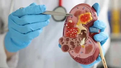 Hiçbir belirti vermeyen böbrek taşlarının zamanla böbrek kaybına yol açabileceğini