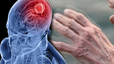Parkinson hastalığı hakkında toplumda farkındalık oluşturmak amacıyla her yıl 11