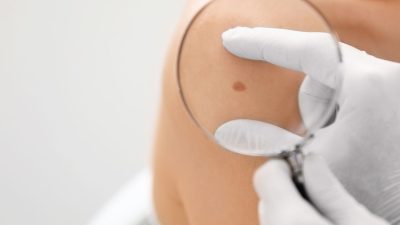 Cilt kanserinin yetişkin ve çocuklarda görebildiğine dikkat çeken Tıbbi Onkoloji