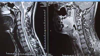 MS (Multiple Skeleroz) hastalığının her bireyde farklı bir şekilde gelişebileceğinin
