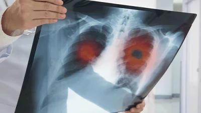 Medical Point Gaziantep Hastanesi Göğüs Cerrahisi Uzmanı Op. Dr. Murat