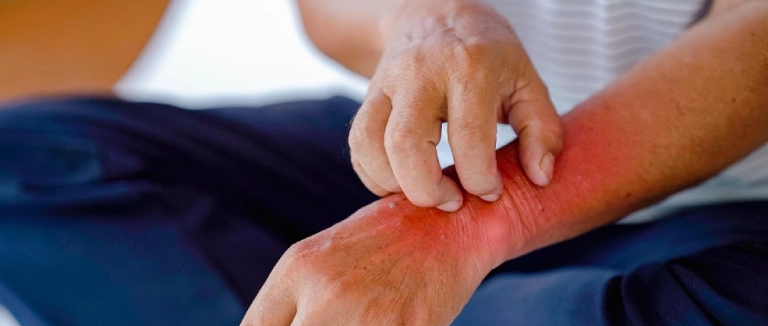 Uzmanlar, kış aylarında artan soğuk ve kuru havanın egzama şikâyetlerini