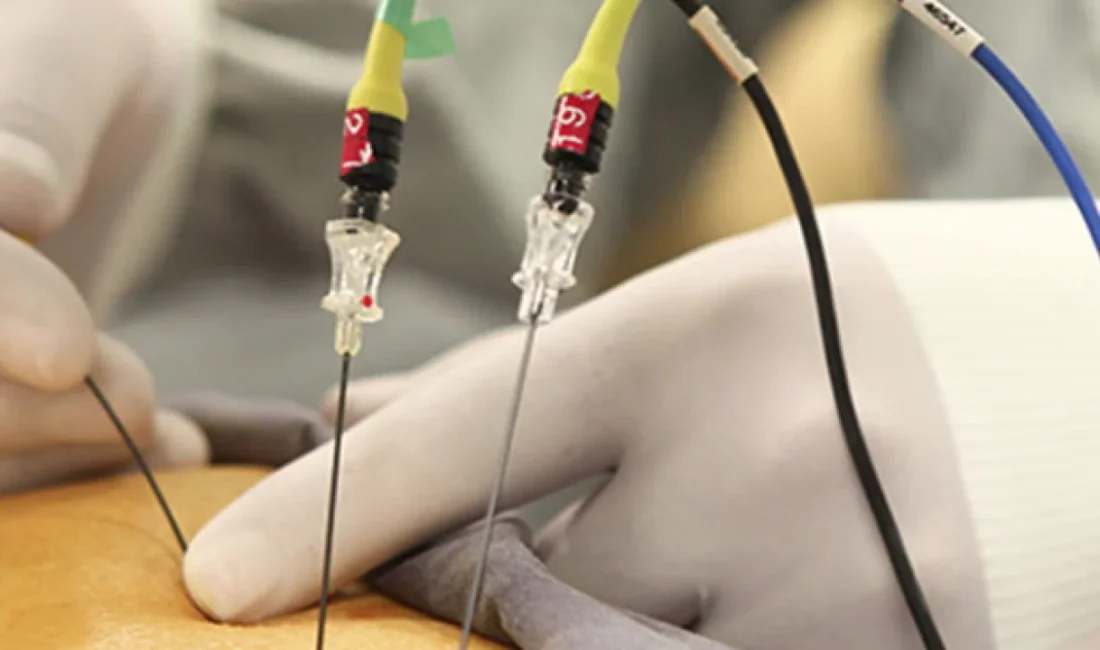 Fizik Tedavi ve Rehabilitasyon Uzmanı Prof. Dr. İrfan Koca, radyofrekans