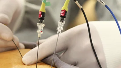 Fizik Tedavi ve Rehabilitasyon Uzmanı Prof. Dr. İrfan Koca, radyofrekans