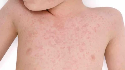 Çocuk Sağlığı ve Hastalıkları Uzm. Dr. Mesut Arslan, bahar ayları