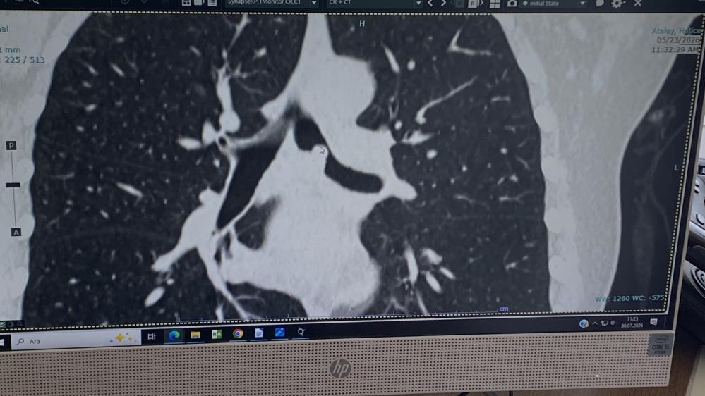 Kocaeli'de sol ana bronşunda tümör bulunan bir hasta, akciğer dokusu