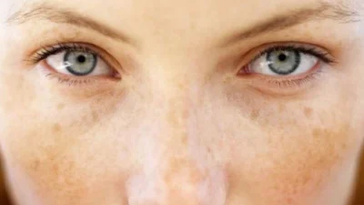 Dermatoloji Uzmanı Dr. Gülbiye Güler, yaz aylarında yoğun güneş maruziyetinin