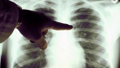 Akciğer tomografisinde nodül görülmesinin her zaman kanser anlamına gelmediğini belirten